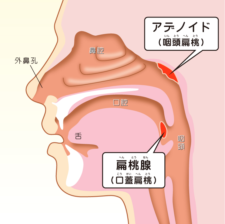 子供 肥大 扁桃 腺