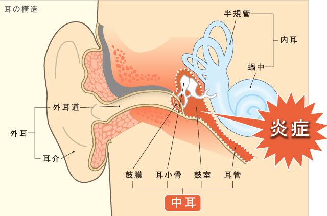 中耳炎とは 杉並区荻窪の耳鼻科 耳鼻咽喉科 荻窪中尾耳鼻咽喉科 睡眠時無呼吸症候群の専門治療