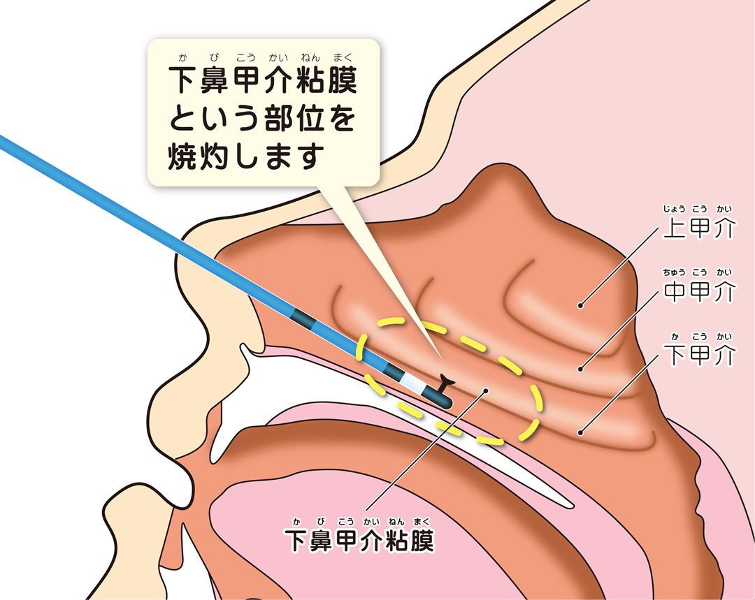 アレルギー性鼻炎 杉並区荻窪の耳鼻科 耳鼻咽喉科 荻窪中尾耳鼻咽喉科 睡眠時無呼吸症候群の専門治療