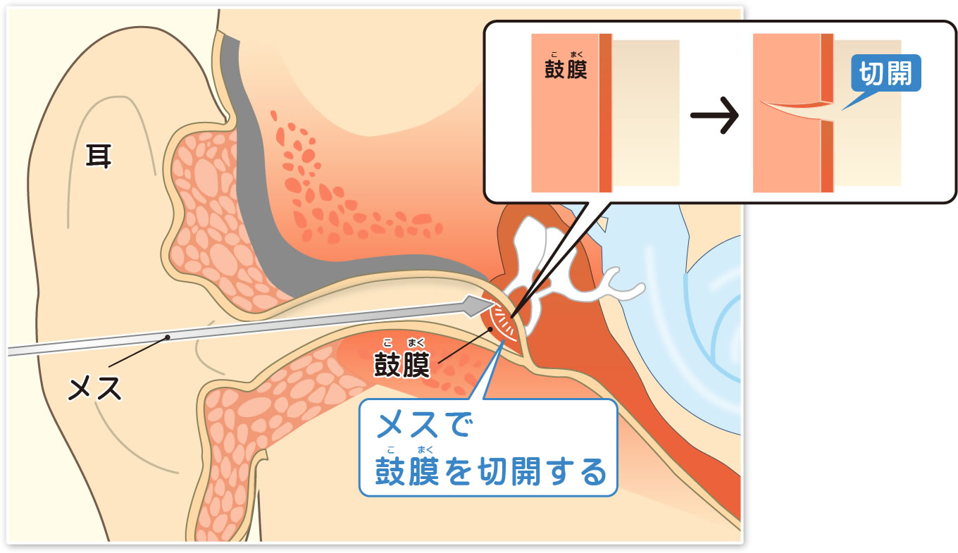 抜け 耳 ない 水