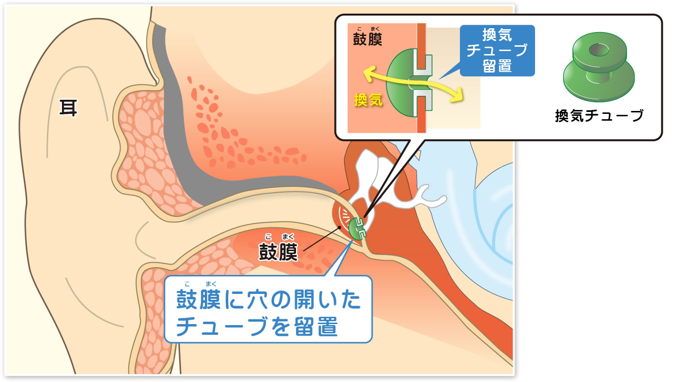 チューブ留置法