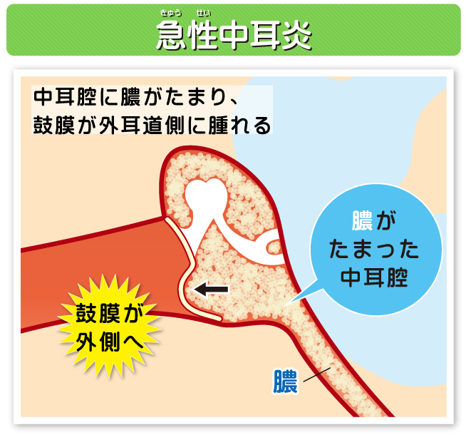 中耳炎とは 杉並区荻窪の耳鼻科 耳鼻咽喉科 荻窪中尾耳鼻咽喉科 睡眠時無呼吸症候群の専門治療