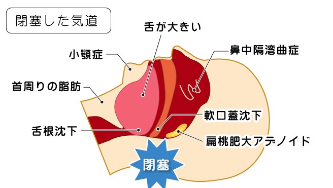 いびきの原因